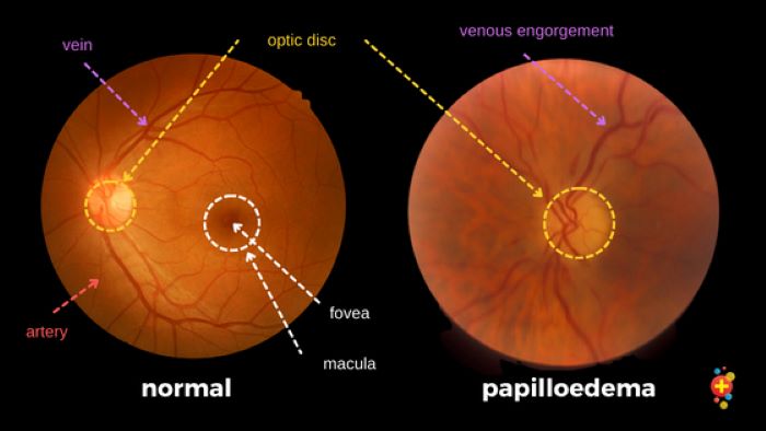 मष्तिस्कको असरबाट आँखामा हुने रोग पैपिल्डेमाको यसरी हुन्छ उपचार