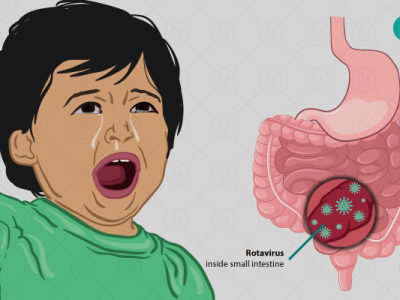 जाडोमा बालबालिकालाई ‘रोटा भाइरस’ को जोखिम