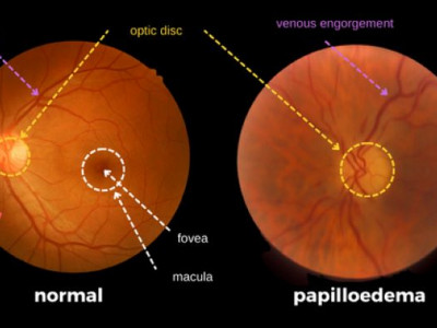 मष्तिस्कको असरबाट आँखामा हुने रोग पैपिल्डेमाको यसरी हुन्छ उपचार